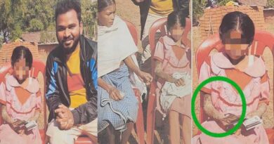 पत्थर शरीर वाली बच्ची के उपचार को लेकर बाल आयोग सक्रिय